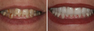 Detroit Dentist Before - After 15