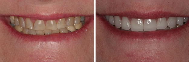 Detroit Dentist Before - After 24