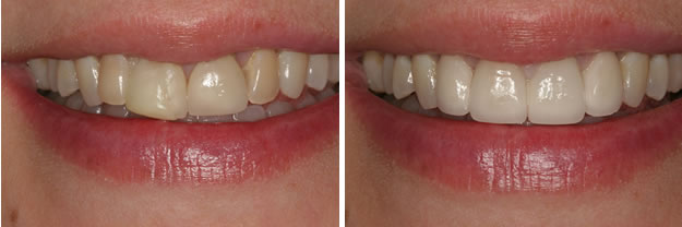 Detroit Dentist Before - After 36