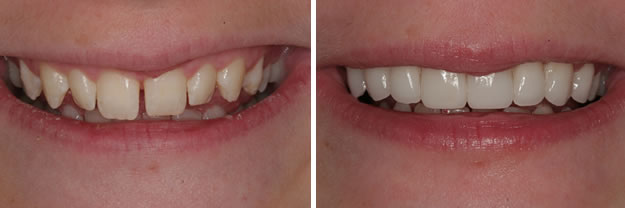 Detroit Dentist Before - After 39