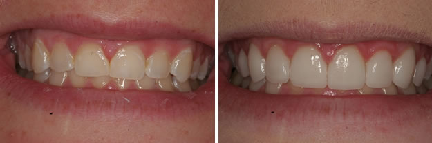 Detroit Dentist Before - After 50