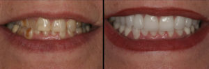 Detroit Dentist Before - After 01