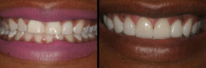 Detroit Dentist Before - After 12
