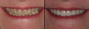 Detroit Dentist Before - After 14