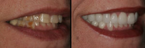 Detroit Dentist Before - After 02