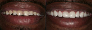 Detroit Dentist Before - After 20
