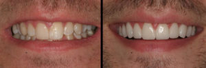 Detroit Dentist Before - After 22