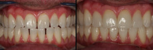 Detroit Dentist Before - After 25