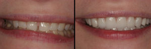Detroit Dentist Before - After 27