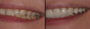 Detroit Dentist Before - After 29
