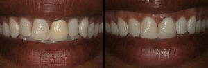 Detroit Dentist Before - After 31