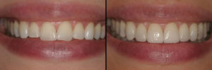 Detroit Dentist Before - After 37