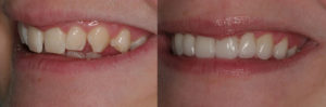 Detroit Dentist Before - After 48