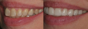 Detroit Dentist Before - After 56