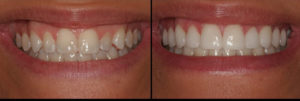 Detroit Dentist Before - After 58