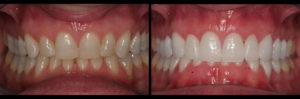 Detroit Dentist Before - After 06