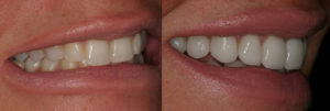 Detroit Dentist Before - After 64