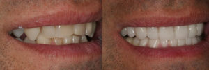 Detroit Dentist Before - After 71