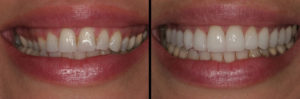 Detroit Dentist Before - After 08
