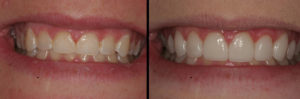 Detroit Dentist Before - After 85