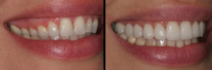 Detroit Dentist Before - After 09