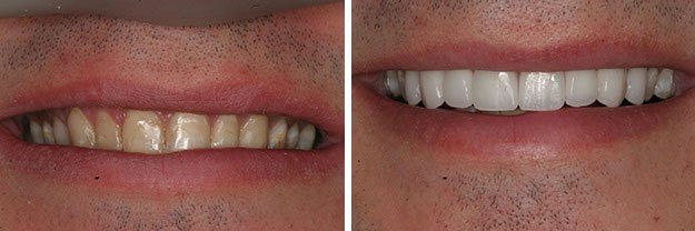 DiPilla Cosmetic Dentist Before After 1