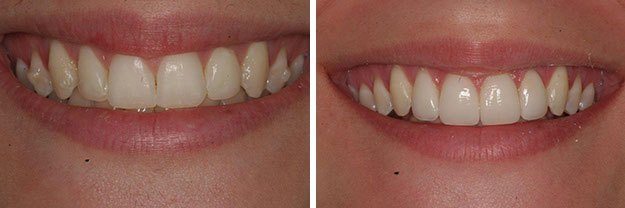 DiPilla Cosmetic Dentist Before After 10