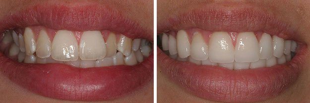 DiPilla Cosmetic Dentist Before After 11