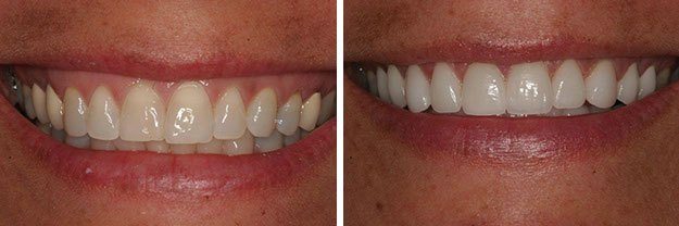 DiPilla Cosmetic Dentist Before After 12