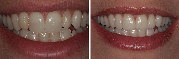DiPilla Cosmetic Dentist Before After 13