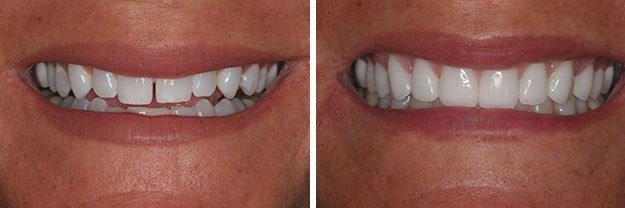DiPilla Cosmetic Dentist Before After 2