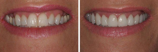 DiPilla Cosmetic Dentist Before After 3