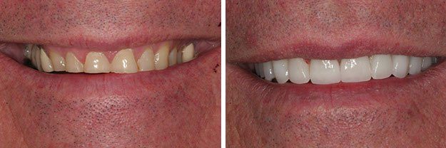 DiPilla Cosmetic Dentist Before After 4