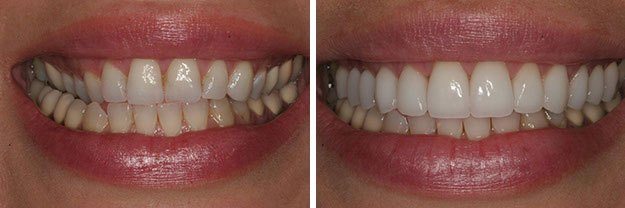 DiPilla Cosmetic Dentist Before After 5