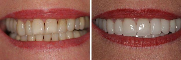 DiPilla Cosmetic Dentist Before After 6