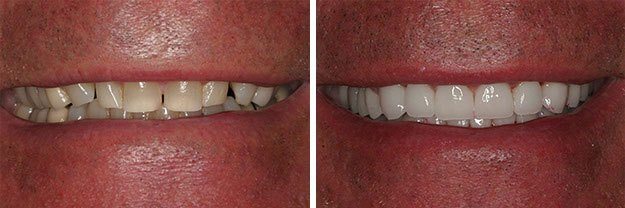 DiPilla Cosmetic Dentist Before After 7