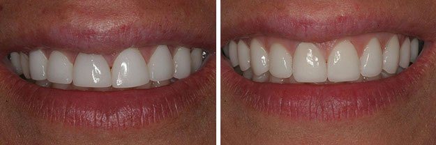 DiPilla Cosmetic Dentist Before After 8