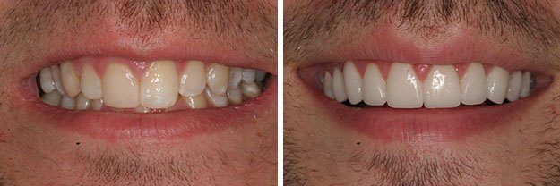 DiPilla Cosmetic Dentist Before After 9